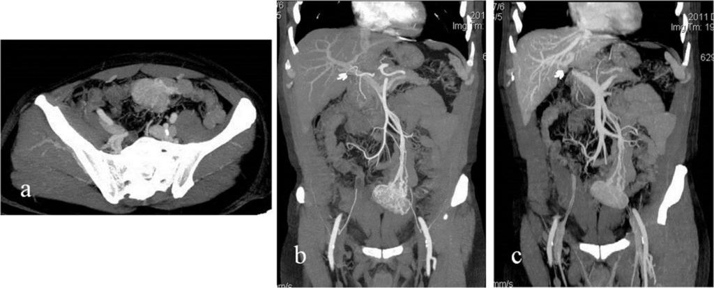 4: Acute lower gastrointestinal tract bleeding in a 40-year-old man.