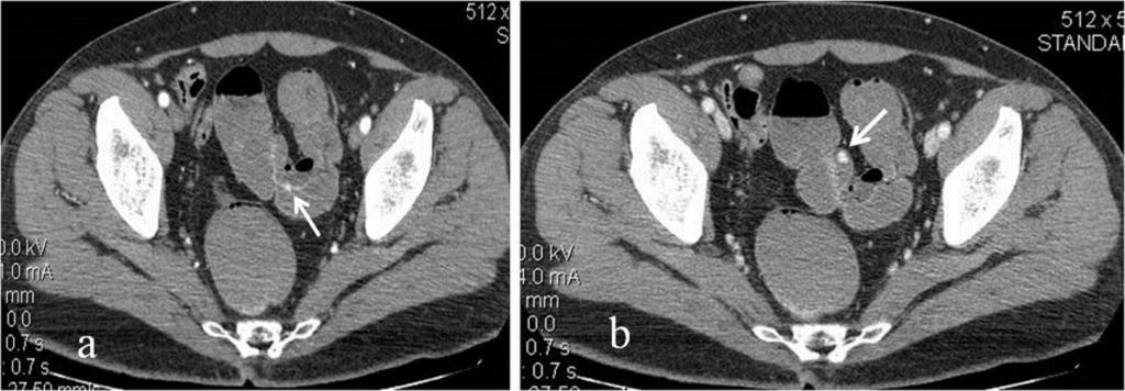 Fig. 5: Active left colonic bleeding in a 55-year-man who was on double antiplatelet therapy. Axial arterial phase [a] demonstrates extravasation of contrast material in the large bowel [arrow].