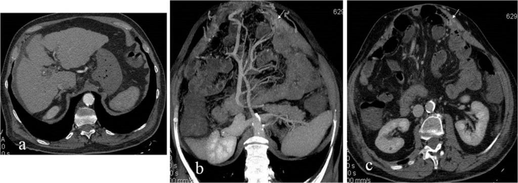 Patient was treated surgically. Fig. 8: Varices in a 70-year-old man with cirrhosis. Axial image [a] demonstrate cirrhotic liver. CT angiography showed no active bleeding.