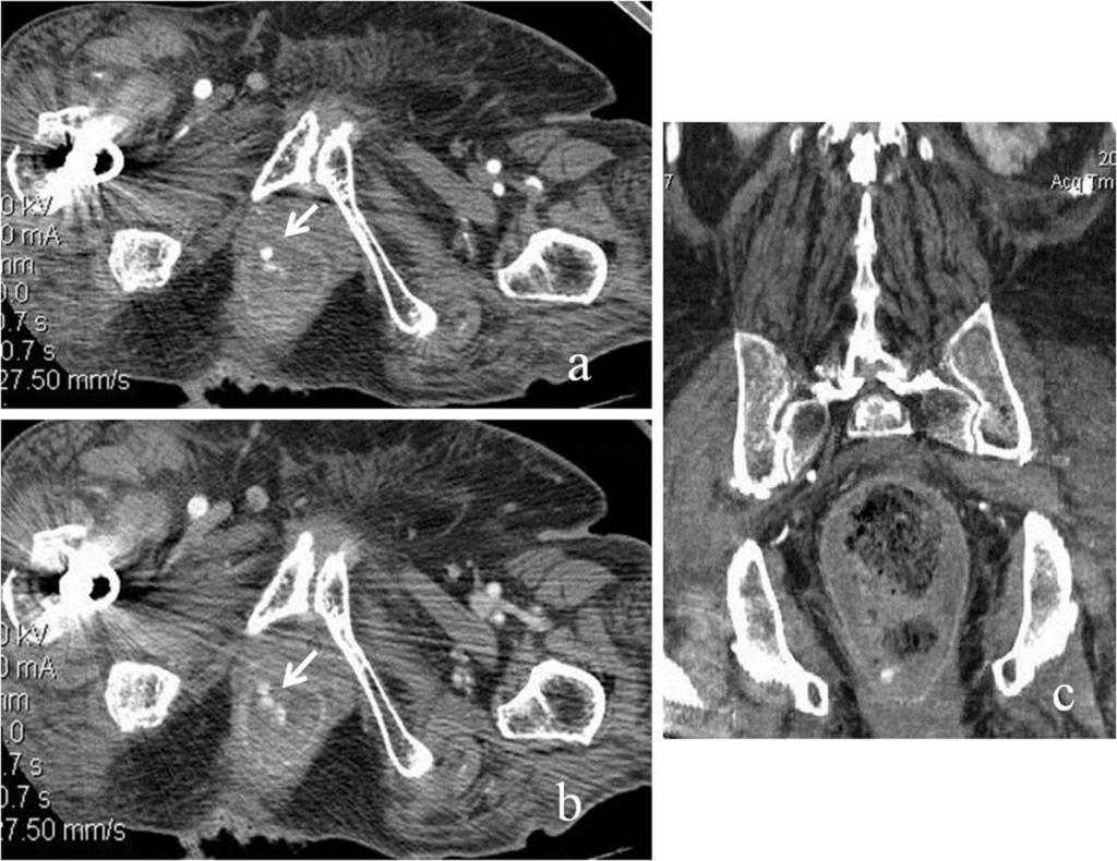 Fig. 9: Solitary rectal ulcer in a 85-year-old woman who presented with brisk hematochezia.