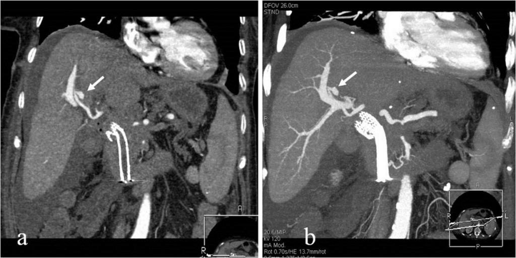 Fig. 10: A 70-year-old woman presented with melena, a week after percutaneous transhepatic cholangiography and biliary metal stents placement due to malignancy.