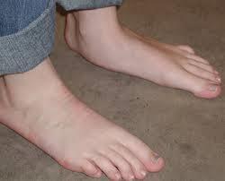 Anomalies of the foot Flat foot (pes planus): Rotation of the calcaneous,eversion of the plantar surface,
