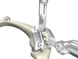 TriathlonKneeSystem Express Instruments Surgical Protocol 2. Chisel and Saw: Assemble the Box Chisel and insert into the slot. Impact with a mallet until seated to the stop.