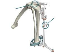 TriathlonKneeSystem Express Instruments Surgical Protocol > Attach the Femoral Impactor Extractor to the Slap Hammer and remove the PS or CR Femoral Trial from the femur.