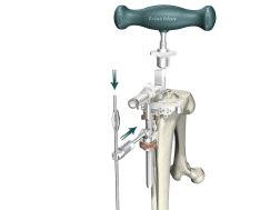 Instrument Bar 6541-4-538 3/8" IM Drill 6541-4-801 Universal Driver (Tibial Resection Guide shown) Figure 25 6541-4-800 T-Handle Driver 6541-4-516 5/16" IM Rod Tibial Preparation Varus/Valgus