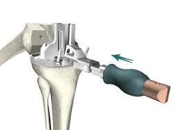 Place two Headless Pins in the anterior holes of the Universal Tibial Template, disassemble the Tibial Trial Insert from the Universal Tibial Template, and secure by pinning.