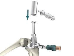 Instrument Bar See Catalog CR & PS Femoral Trials See Catalog Universal Tibial Template 6541-4-003 Headless Pins - 3" Tibial Preparation Figure 31 > Place the appropriate Keel Punch into the Keel
