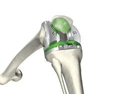 Drill three fixation holes with the appropriate drill (Metal-backed patella or All Poly). > If a cemented component is to be used, prepare the resected bone surfaces for bone cement application.