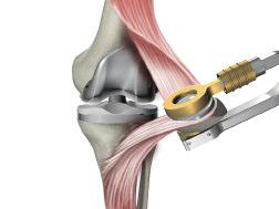 Tibial Insert > Prior to assembly of the Tibial Insert, the Tibial Trial Insert may be placed on the Primary Tibial Baseplate to once more assess joint stability and range of motion.
