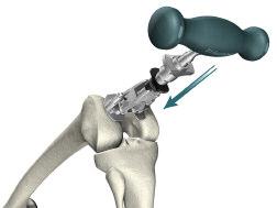 It is approximately 1cm anterior to the femoral attachment of the posterior cruciate ligament and slightly medial to the midline of the distal femur.
