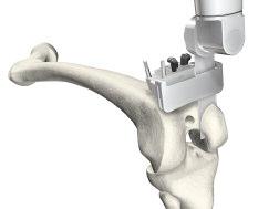 Button Note: If the medial O pin hole is too close to the edge of the bone (on smaller femurs), use the holes marked 2 which are closer to the center of the bone.
