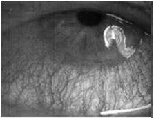 GVHD DED is the most commonly found eye condition in GVHD DED is a diagnostic sign of chronic GVHD Limited success for DED treatment in GVHD patients Ocular surface