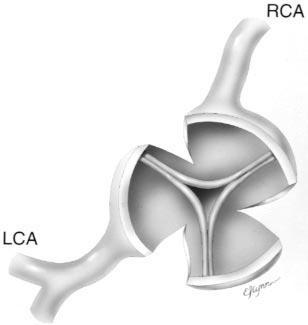 RCA, Right coronary artery; LCA, left coronary artery. aorta after longitudinal incision through the stenotic region extending into the noncoronary sinus in 34 cases (Fig 2, A).