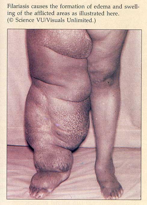 Oedema from Reduced Lymph Flow Elephantiasis (Filariasis) is produced by blockage and of lymphatic vessels and reduced lymph flow.