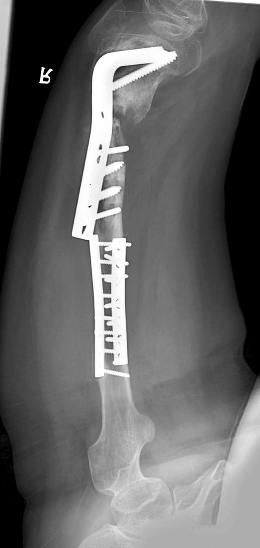 Osteosarcoma Femur 16 End-to-side 20 5 NED 3 F/22 Osteosarcoma Femur 25 End-to-end 30 3 NED 4 M/34 Osteosarcoma Femur 10 End-to-side 15 4 NED 5 F/13 Osteosarcoma Femur 14 End-to-end 19 5 NED 6 M/35