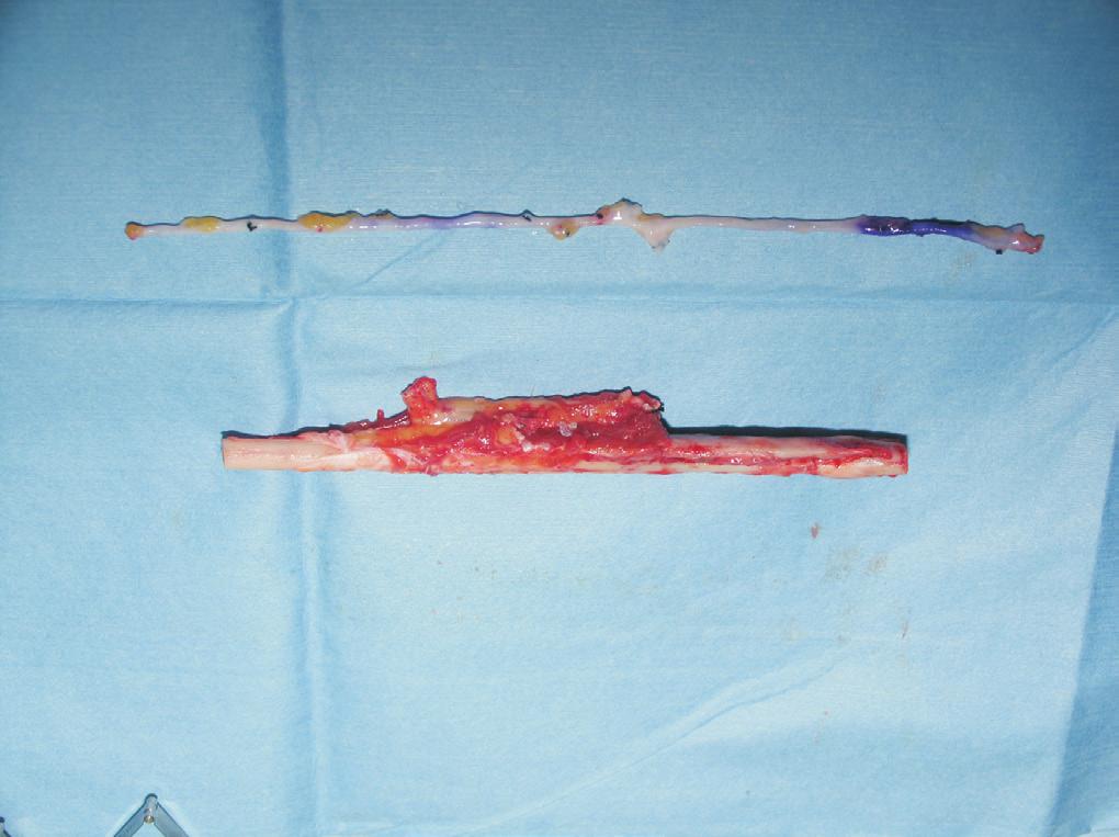 Arch Reconstr Microsurg Vol. 24. No. 2. November 2015 an in-lay (intramedullar) graft and fixated with locking plate with screws to enhance the graft stability.