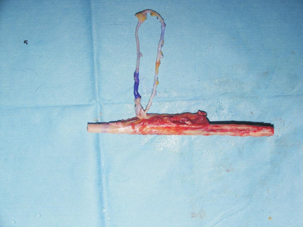 The donor peroneal artery was anastomosed to the branch of the femoral artery by the end-to-end technique in three and in four it was by the end-to-side anastomosed directly to the femoral artery.