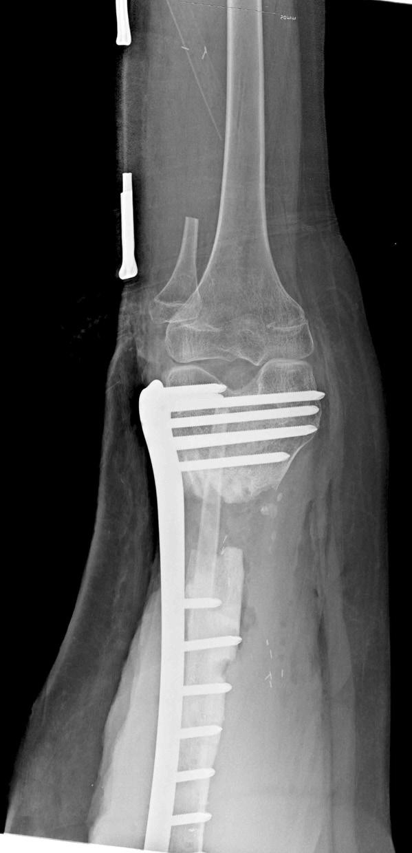 5. During the follow-up period, fibular graft underwent a stress fracture under the protection