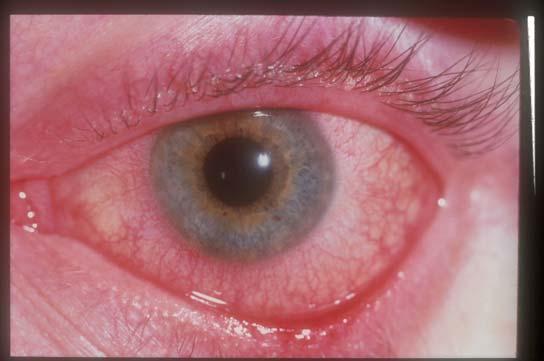 2. IDENTIFYING DISEASE AFFECTING THE EYE - in ICU patients there are 3 main eye problems that need to be identified a) Conjunctivitis - for you to diagnose this, the eye must be sticky and is usually