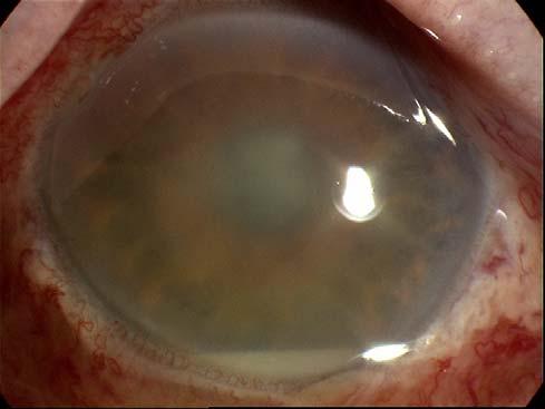 b) Red eye in a septic patient or/and white line visible in eye - this is potentially a very serious problem and can indicate spread of the infection in the blood stream to the eye.