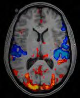 Functional Magnetic Resonance Imaging (fmri) shows brain activity at rest or during performance of various tasks