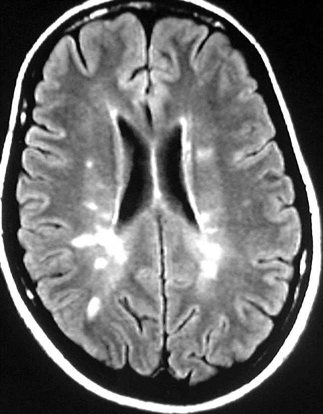 MRI Evidence of Dissemination of Lesions