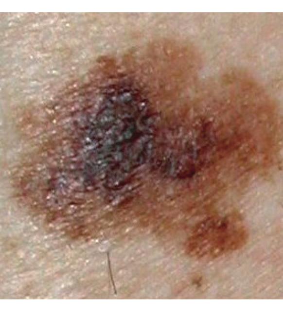 Malignant melanoma is the rarest form of skin cancer but is the most serious and can kill.