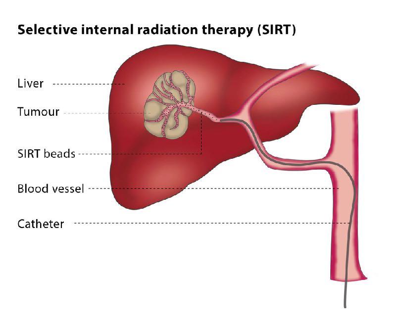 Selective internal radiotherapy (SIRT) Biocompatible polymer resin microspheres of a median diameter of 32.