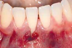 9 The use of HA during surgical and non-surgical periodontal treatment may also improve periodontal parameters.