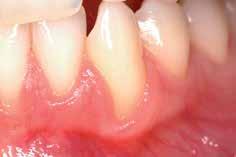 TREATMENT OF A GINGIVAL RECESSION CLINICAL CASE PROVIDED BY PROF ANDREA