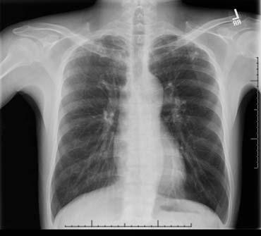 as a post-doctoral fellow Known abnormal CXR with