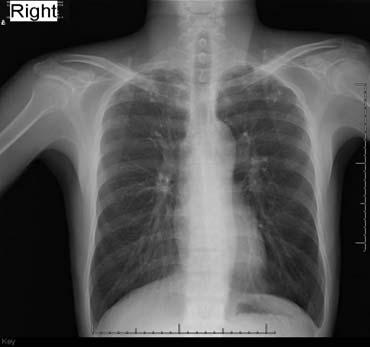 Managing patients with abnormal CXR s and (+) PPD s Option #1: Collect sputum for AFB analysis Begin multidrug tuberculosis Rx Reevaluate at 2 months: if (+) cultures or radiographic improvement