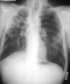 atypical; lower lobe infiltrate, adenopathy or completely normal
