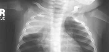 Progressive Primary TB: Radiographic Findings Parenchymal disease: areas of greatest ventialtion-lower and middle lobes Lymphadenopathy Pleural