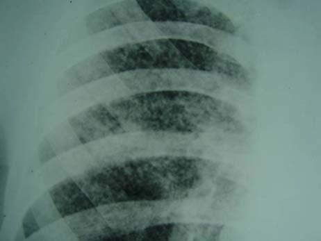 Miliary TB Normal radiographic findings in the early stages, 25%-40% at initial
