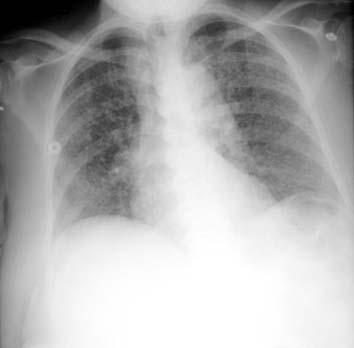 by innumerable, 1-3mm noncalcified nodules in both lungs with mild basilar predominance