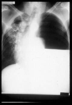 TB and AIDS: Radiographic Appearance The radiographic manifestations of HIVassociated pulmonary TB are dependent
