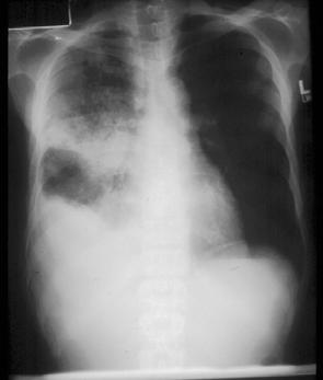 TB and AIDS: Radiographic Appearance The presence of