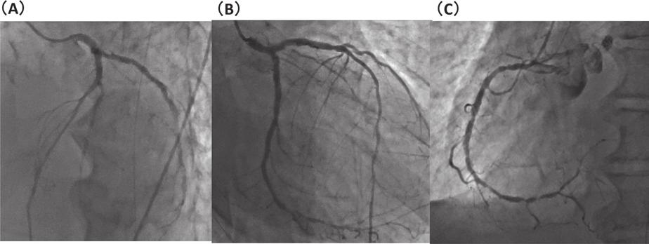 72 H. Kimura, et al. Vol. 63, No. 3 cause of acute myocardial infarction with cardiogenic shock. An emergent coronary angiographic examination revealed that he had 3 - vessel disease.
