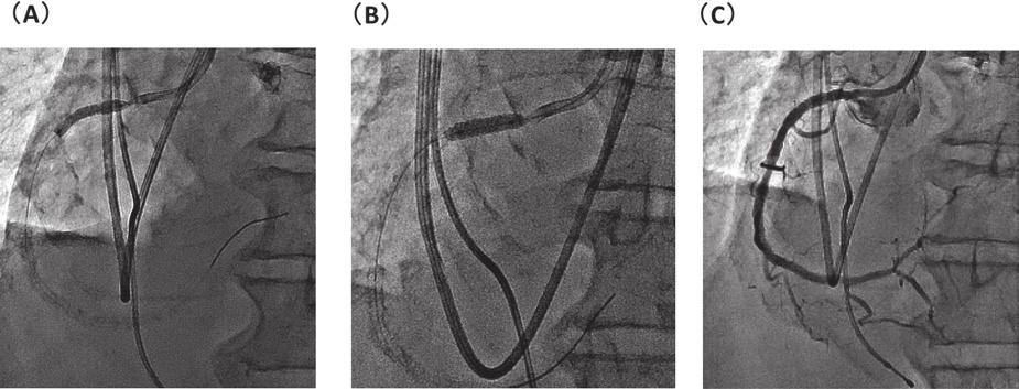 coronary artery, and from the proximal to the middle segments of the left circumflex coronary artery.