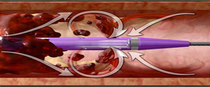 AngioJet TM Thrombectomy Systems Mechanical removal of thrombus, or Combination of chemical and mechanical thrombolysis Power Pulse Delivery enables infusion of physician-specified fluids directly