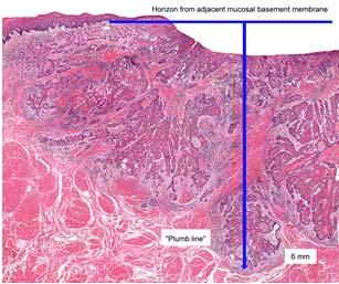 advanced local disease Tumor invades adjacent structures only Tumor > 4 cm with DOI* > 10 mm (e.g.