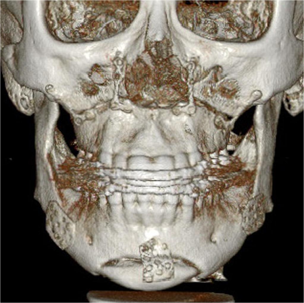 Park Maxillofacial Plastic and Reconstructive Surgery (2015) 37:6 Page 5 of 9 Figure 5 3-dimensional reconstructed CT image showing maxillomandibular osteotomy with simultaneous genioplasty and