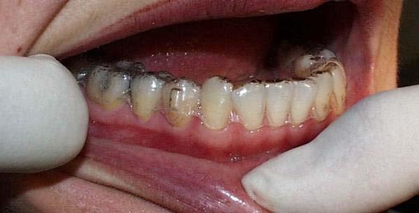 teeth Good Fit No visible gaps or