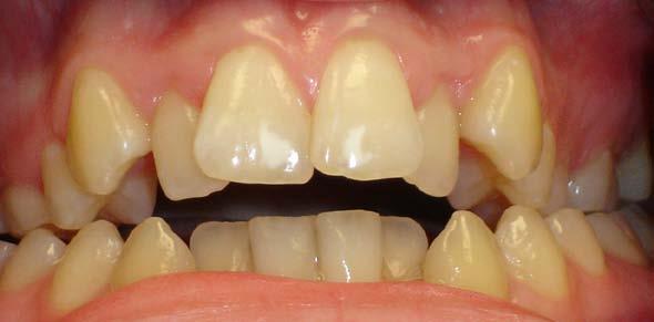 Aligner Too Retentive Prevention Divergent path of insertion due to severely tipped, crowded or flarred teeth Trim away aligner in undercut region with trimming bur Trim the distal of the terminal