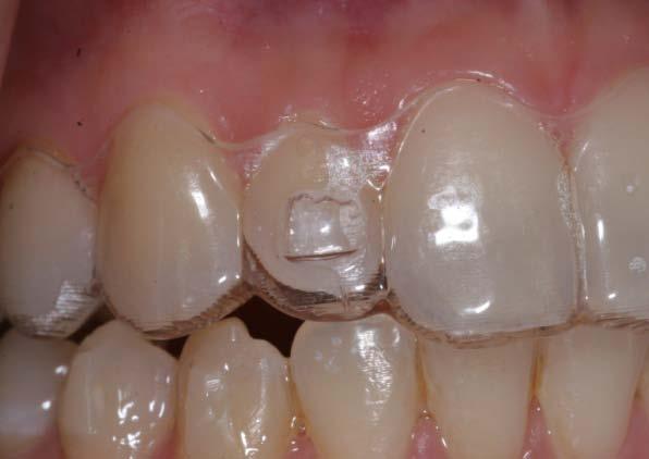 Tooth Not Extruding Prevention Attachment not optimally engaged (slightly) Attachment not optimally engaged (significantly) Have patient bite into cotton rolls/ chewies frequently to help seating and