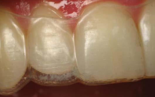 Unplanned Intrusion Prevention Inadequate IPR (insufficient space), causing aligner to squeeze tooth apically Evaluate M-D space and any binding contacts with unwaxed floss and relieve with finishing