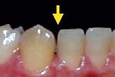 Residual Spacing IMPORTANT NOTE: Not enough time for movement to express due to variation in bone biology, tooth morphology or patient compliance Excessive IPR Extend wear time Request virtual