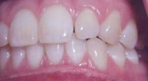 Residual Spacing Prevention Residual space present in the doctor s ClinCheck treatment plan when there s no space to retract the teeth due to lack of overjet/tooth size discrepancy Restore Request