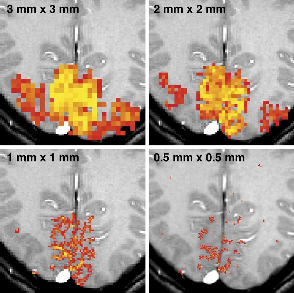 12 J. Frahm et al. / Progress in Nuclear Magnetic Resonance Spectroscopy 44 (2004) 1 32 Fig. 7. BOLD MRI activations as a function of spatial resolution.
